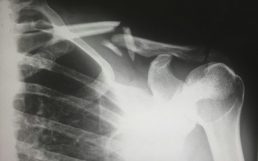 X-ray chart showing shoulder injury